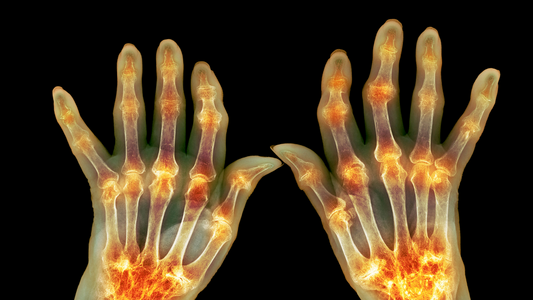 Arthritis – The Inflammatory Disease